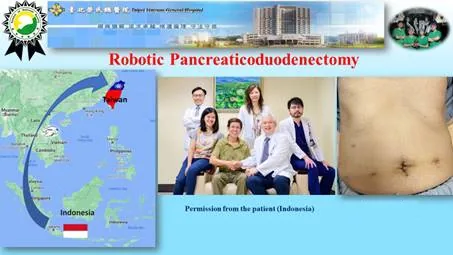 Indonesia International Medical is offering minimally invasive Da Vinci pancreaticoduodenectomy surgery