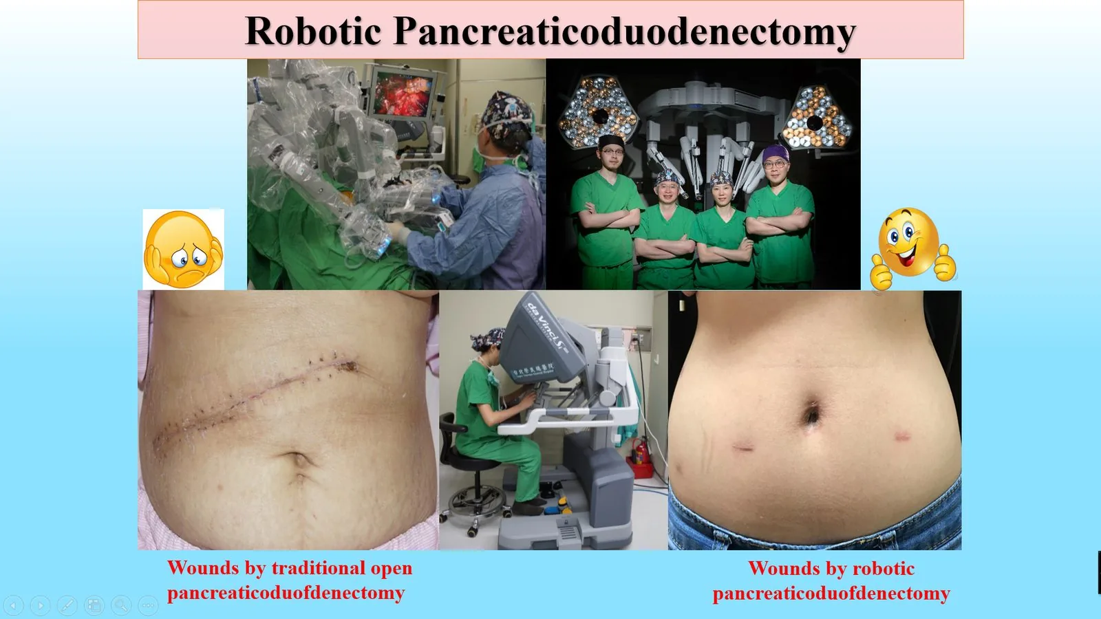Minimally Invasive Robotic Pancreatic Surgery - Small Wound for Major Pancreatic Surgery