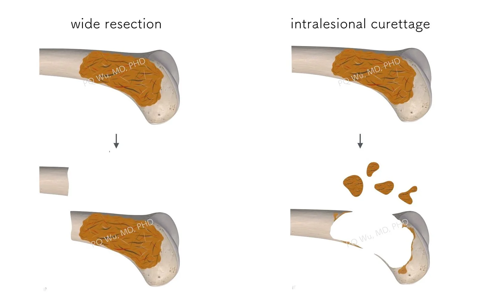 bone metastasis surgery pqwu
