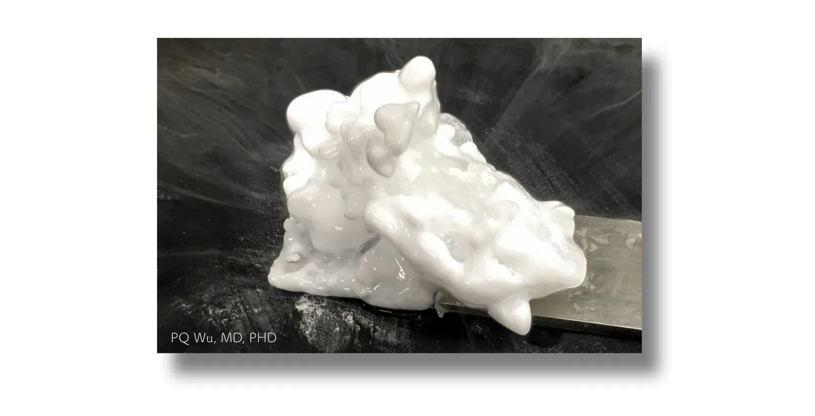 cryotherapy bone tumor pqwu