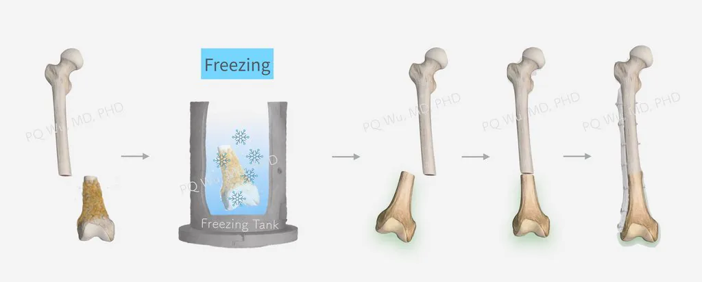 Taiwan healthcare, Taiwan medical, Taipei veterans general hospital, biological reconstruction, osteosarcoma, sarcoma, limb salvage, limb reconstruction, freezing, liquid nitrogen