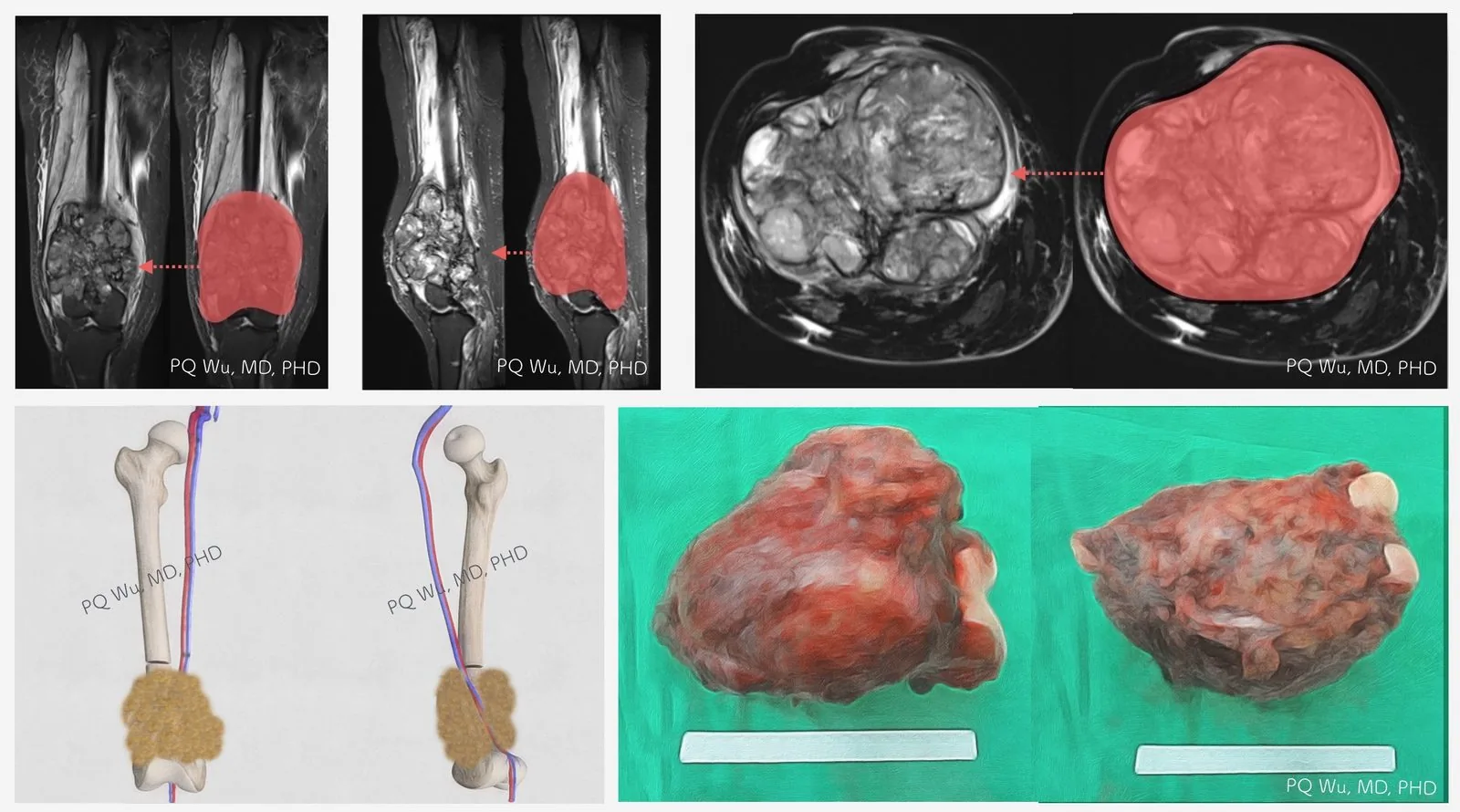 Bone sarcoma Treatment (Wide Resection Surgery)
