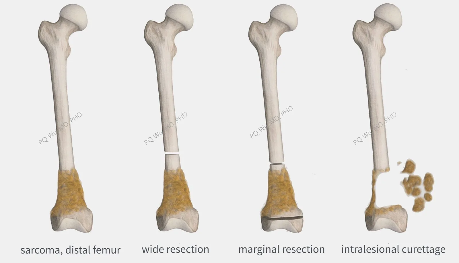 Bone sarcoma Treatment (Wide Resection Surgery)