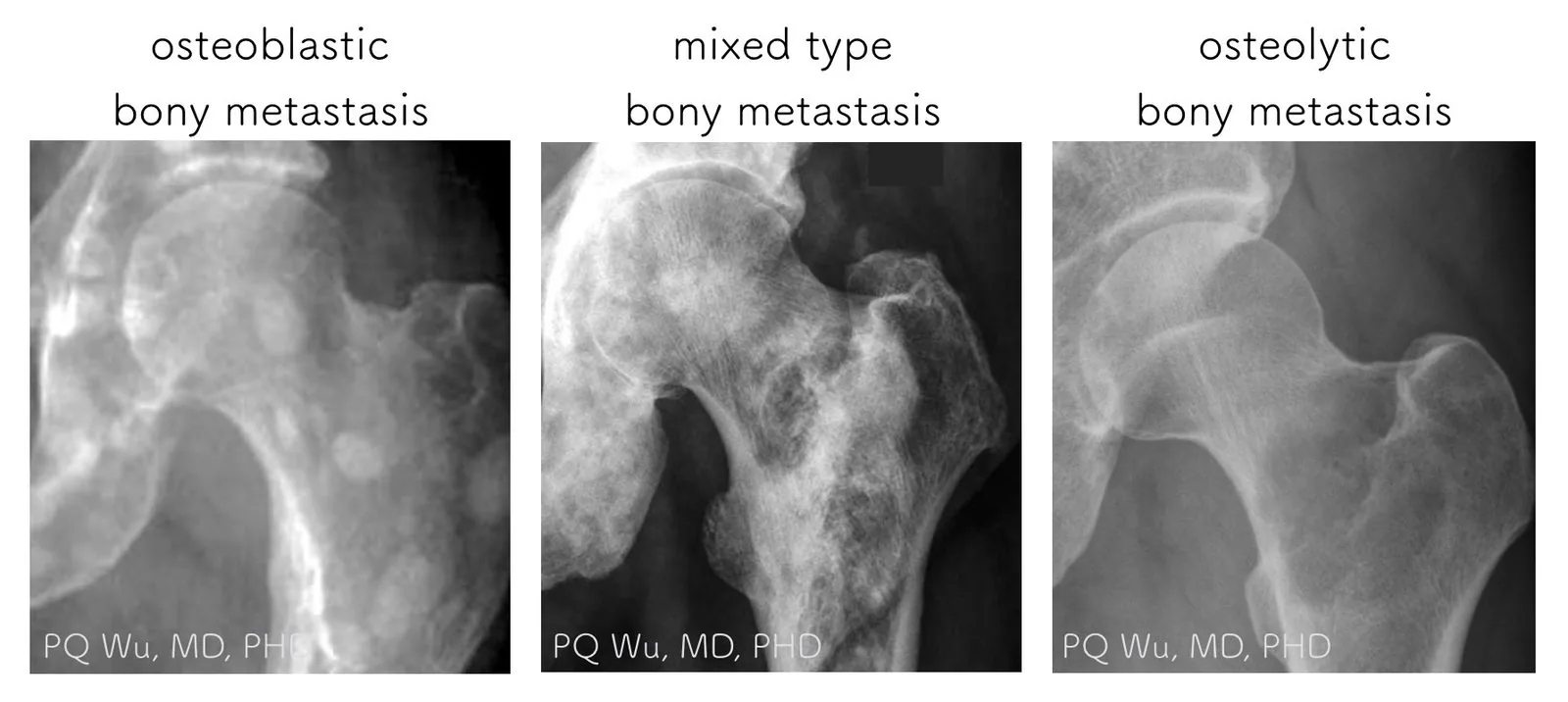 bone metastasis pqwu