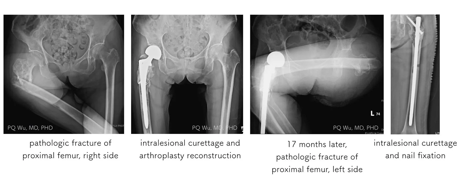 bone metastasis hemiarthroplasty nailing pqwu