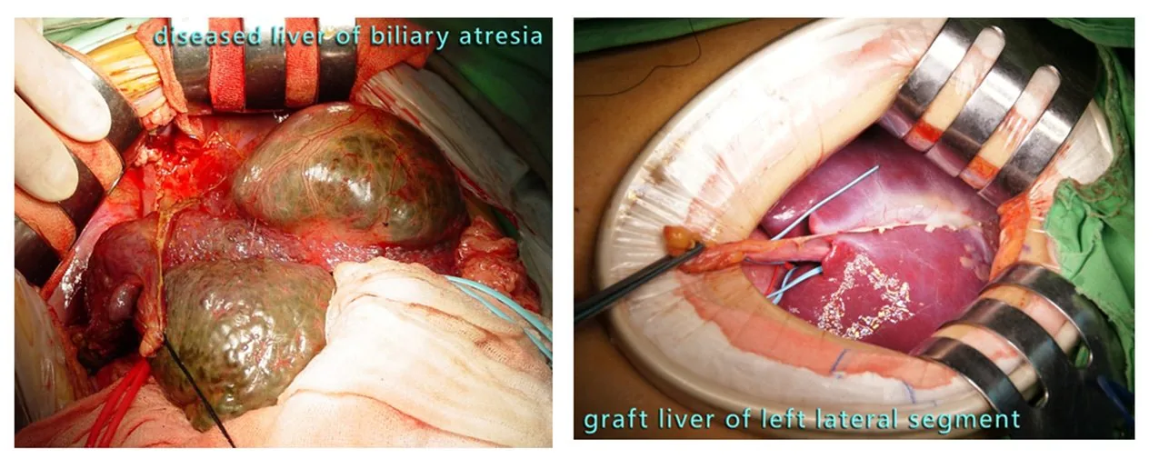 Living liver Transplantation