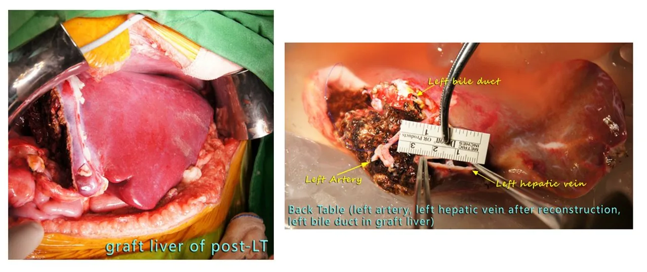 Living liver Transplantation