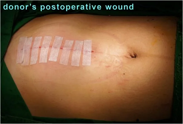 Living liver Transplantation