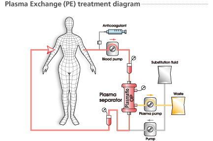 Plasmapheresis