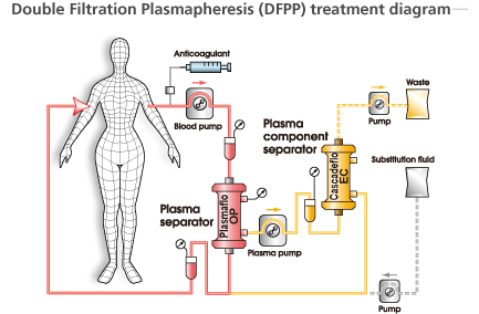 Plasmapheresis