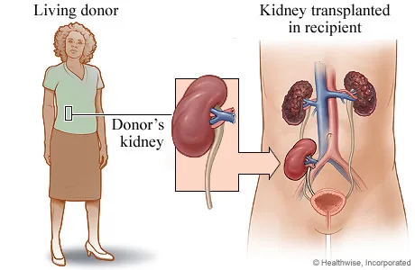 Kidney transplantation