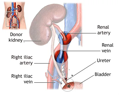 Kidney transplantation