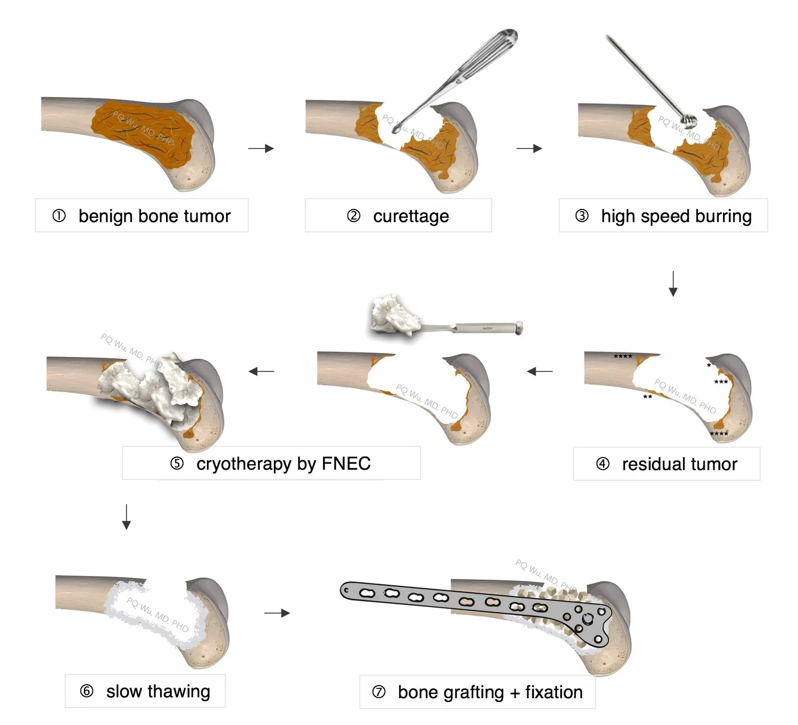 cryotherapy bone tumor fnec pqwu