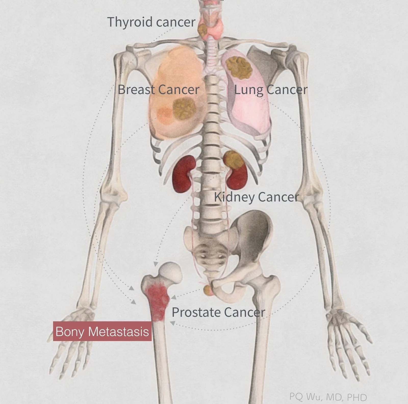 bone metastasis pqwu